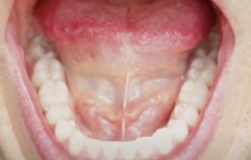Bottom Inside View of Teeth