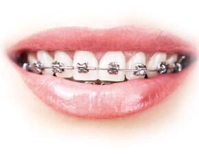 Damon self-litigating braces