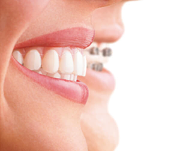 What are the benefits of Invisalign?