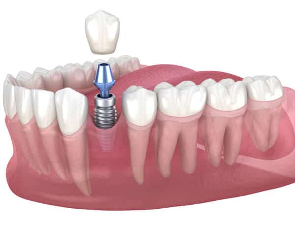 dental implants