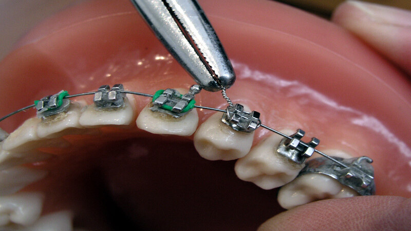 Fixed Braces Solutions