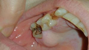 Teeth Get Infected