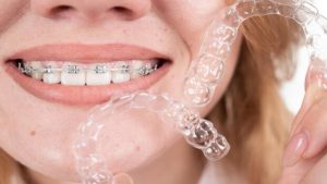 Invisalign and Traditional Braces